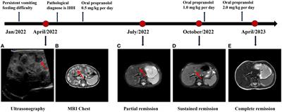 Diffuse infantile hepatic hemangioma successfully treated with propranolol orally: a case report and literature review